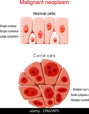 Neoplasia maligna. Cancro e cellule normali. Confronto e differenza tra tessuto sano e tumore. Dettagli su cromatina, nucleo Illustrazione Vettoriale