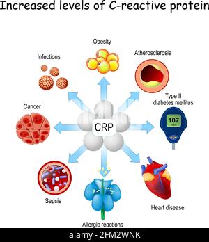 La CRP è un biomarcatore dell'infiammazione e dell'infezione. Aumento dei livelli di proteina C-reattiva e rischio di sviluppare diverse malattie da diabete, allergico Illustrazione Vettoriale