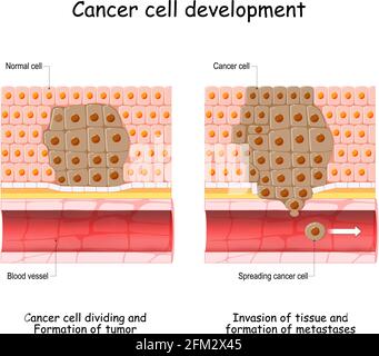 Sviluppo del cancro dalla cellula normale alla formazione del tumore, diffusione delle cellule tumorali nel flusso sanguigno, invasione di altri tessuti e formazione di metastasi Illustrazione Vettoriale