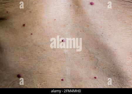 Le talpe rosse, o angiomi ciliegia, sono comuni crescite della pelle che possono svilupparsi sulla maggior parte delle zone del vostro corpo. Sono anche noti come angiomi senili o Campbell Foto Stock