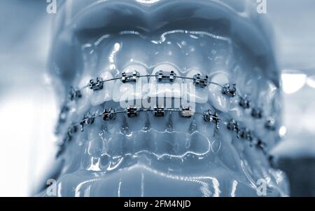 Parentesi graffe su un modello di denti umani, odontoiatria dentale primo piano. Foto Stock