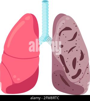 Malattia di infezione da tubercolosi polmonare malsana. Apparato respiratorio umano tubercolo d'organo interno bacillus infettato o polmonite colpito. Anatomia medica infiammazione danno illusrtazione vettore Illustrazione Vettoriale