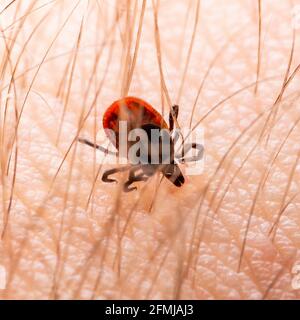 Encefalite infettiva Ixodes Scapularis o Persulcatus Deer Tick Insect sulla pelle. Encefalite virus o malattia di Lyme borreliosi infetta Ixodes Tick Foto Stock