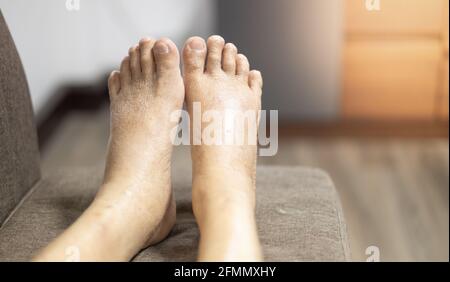 I piedi del vecchio uomo rughe pelle gonfia piedi con il cancro e la mancanza di corpo della proteina per la salute in modo non buono. Foto Stock