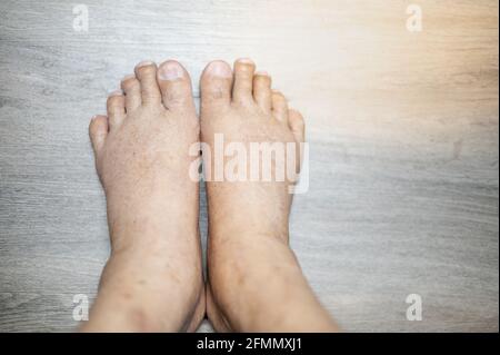 I piedi del vecchio uomo rughe pelle gonfia piedi con il cancro e la mancanza di corpo della proteina per la salute in modo non buono. Foto Stock