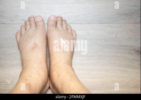 I piedi del vecchio uomo rughe pelle gonfia piedi con il cancro e la mancanza di corpo della proteina per la salute in modo non buono. Foto Stock