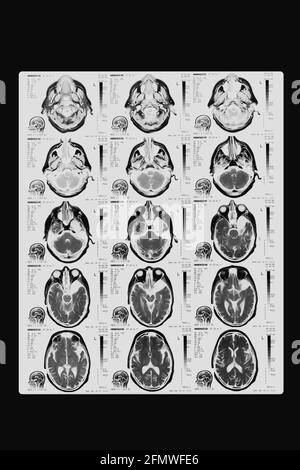 Immagine di tomografia computerizzata delle regioni cerebrali umane. Pellicola a raggi X in bianco e nero Foto Stock