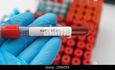 Test prenatale NIPT o non invasivo, diagnosi del risultato del test della sindrome da discesa fetale con campione di sangue in provetta presso il medico in laboratorio medico Foto Stock