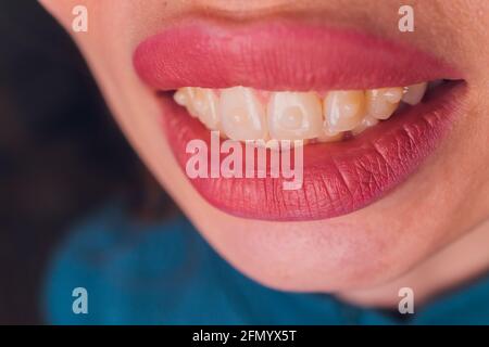 Sistema Brasket in bocca sorridente di una ragazza, macro fotografia dei denti, viso grande e labbra dipinte. Bracelle sui denti di una ragazza che sorride