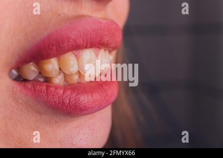 Sistema Brasket in bocca sorridente di una ragazza, macro fotografia dei denti, viso grande e labbra dipinte. Bracelle sui denti di una ragazza che sorride