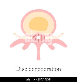 Colonna vertebrale erniata - disco degenerazione. Diagramma vettoriale, disegnato a mano. Infografica dell'ernia di primo stadio del disco intervertebrale Illustrazione Vettoriale