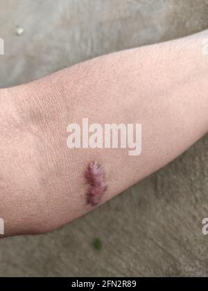 Primo piano della cicatrice keloide su un braccio maschio Foto Stock