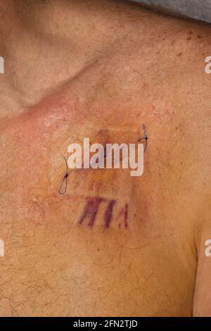 Un pacemaker fresco scar su un maschio di 67 anni Foto Stock