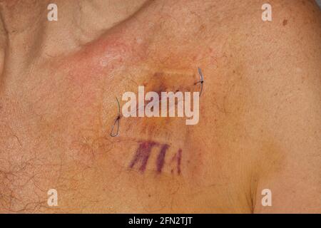 Un pacemaker fresco scar su un maschio di 67 anni Foto Stock