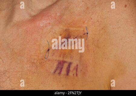 Un pacemaker fresco scar su un maschio di 67 anni Foto Stock