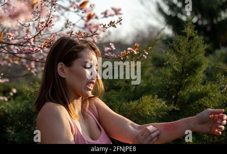 Bella giovane donna graffiare braccio accanto fiore albero nel parco in primavera. Arrossamento e prurito della pelle come reazione allergica Foto Stock