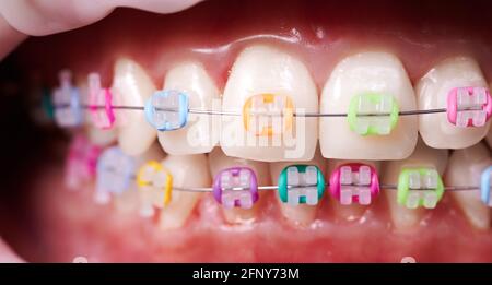 Macro istantanea di denti e bretelle in ceramica con fasce colorate in gomma su di essi. Concetto di odontoiatria e trattamento ortodontico. Foto Stock