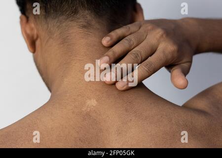 Un uomo indiano che mostra cicatrice bianca sulla sua pelle, concetto sanitario Foto Stock