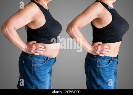 Prima e dopo la perdita di peso Liposuzione Chirurgia Foto Stock