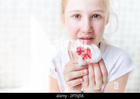 Lana di cotone sanguinante nelle mani di un bambino. Epistassi, sintomo di malattia, trauma. Foto Stock