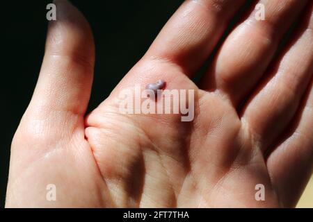 Un blister di sangue sul palmo di una mano aperta Foto Stock