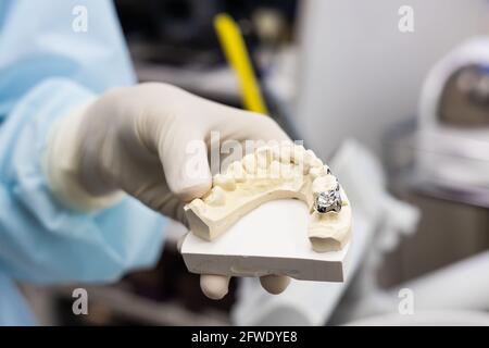 Dentista che tiene la protesi dentaria con la corona metallica sul molare dente Foto Stock