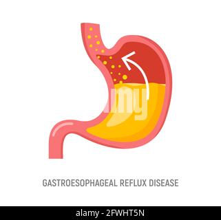 Malattia da reflusso gastroesofageo. Stomaco GERD bruciore di stomaco esofago illustrazione medica Illustrazione Vettoriale