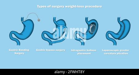 Illustrazione dei tipi di procedura chirurgica di perdita di peso. Foto Stock