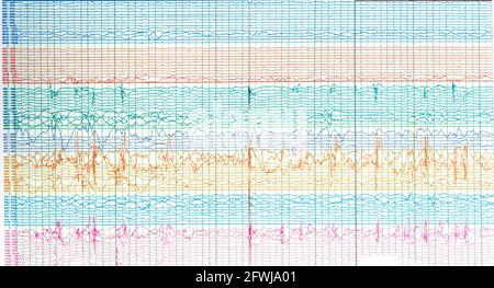 Fotografia di onde cerebrali di pazienti epilettici che presentano onde acuminate durante l'assenza di crisi epilettiche o l'EEG interictal. Foto Stock