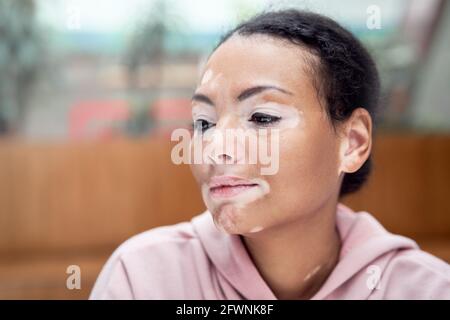 Donna nera afroamericana con pigmentazione vitiligina problema della pelle interna felpa con cappuccio rosa vestita primo piano ritratto pensivo nero pensiero femminile informazioni su Foto Stock