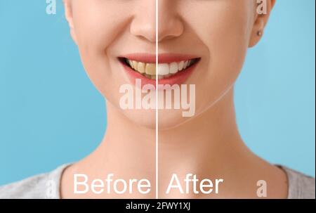 Bella giovane donna prima e dopo il sorriso makeover procedura su sfondo colore, closeup Foto Stock