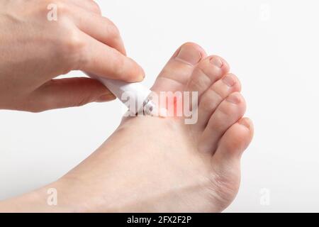 La ragazza applica un unguento healing tra le dita dei piedi contro il peeling e l'irritazione della pelle, un odore sgradevole, dermatologico Foto Stock