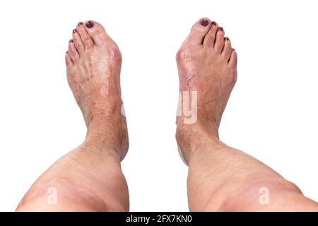 Hallux valgus, bunion sui piedi della donna anziana isolato su sfondo bianco. Deformità dolorosa delle articolazioni dei piedi con disallineamento delle dita dei piedi. Primo piano, vista dall'alto. Foto Stock