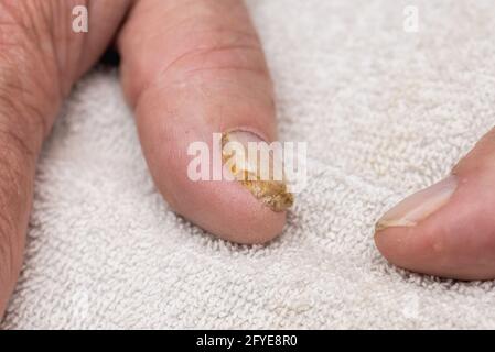 Infezione fungo del chiodo sul dito grande. Infezione fungina sulle unghie mano, dito con onicomicosi.Close up. Foto Stock