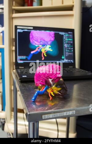 stampa 3d di un rene. Chirurgia renale conservativa robotica guidata da immagini assistita da modellazione 3D, questa modellazione 3D del rene con il suo tumore localizzato i Foto Stock