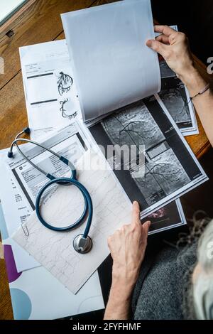 Angiogramma coronarico arteria affetta da stenosi. Foto Stock