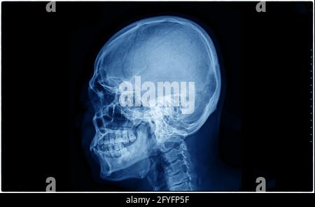 Proiezione laterale del cranio radiogeno e della colonna cervicale, pellicola radiografica delle ossa umane dal naso al torace. Foto Stock