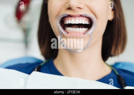 Primo piano ritratto di bella giovane donna seduta in sedia dentale, mentre lo stomatologo mani in guanti sterili che tengono campioni di denti. Sta sorridendo Foto Stock