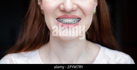 Il sorriso di una giovane ragazza con le parentesi graffe sui denti bianchi. Foto Stock