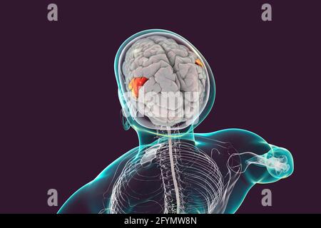 Cervello con gyrus sopramarginale evidenziato, illustrazione Foto Stock