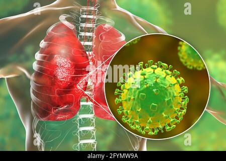 Virus Nipah nei polmoni, illustrazione Foto Stock