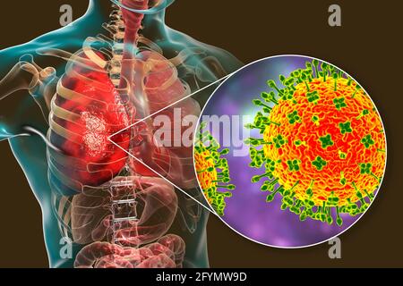 Virus Nipah nei polmoni, illustrazione Foto Stock