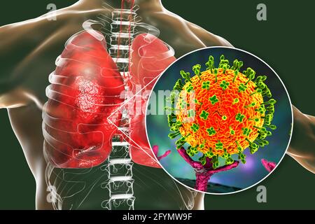 Virus Nipah nei polmoni, illustrazione Foto Stock