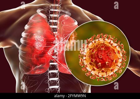 Virus Nipah nei polmoni, illustrazione Foto Stock