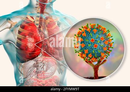 Virus Nipah nei polmoni, illustrazione Foto Stock