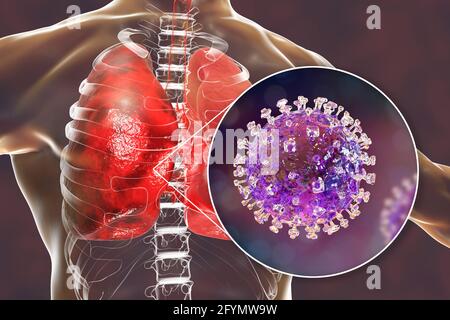 Virus Nipah nei polmoni, illustrazione Foto Stock