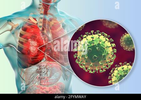 Virus Nipah nei polmoni, illustrazione Foto Stock