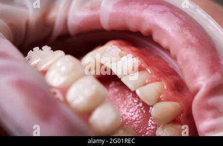 Primo piano del paziente con la bocca aperta che mostra denti bianchi con staffe ortodontiche. Giovane con divaricatore di guancia in bocca che mostra le bretelle dentali. Concetto di odontoiatria, trattamento ortodontico Foto Stock