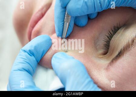 la donna usa il bastone di rimozione dell'acne per rimuovere i pimples di whitehead sulla faccia schiacciando sui pimples che si schiumano, faccia oleosa Foto Stock