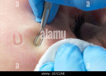 la donna usa il bastone di rimozione dell'acne per rimuovere i pimples di whitehead sulla faccia schiacciando sui pimples che si schiumano, faccia oleosa Foto Stock